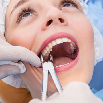 tooth extraction 1